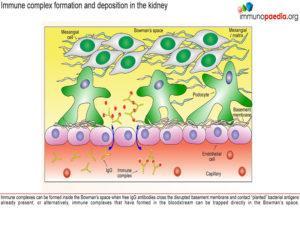 Post-streptococcal glomerular-nephritis_Page_07.1