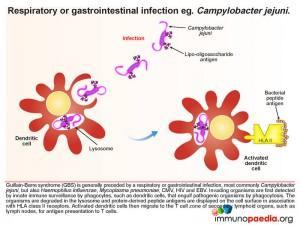Respiratory or gastointenstinal infection eg Campylobacter jejuni