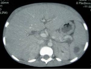 Abdominal CT scan