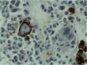 Bone marrow trephine report glycophorin staining of the red cell membrane
