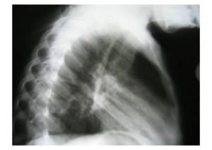 Chest X-ray