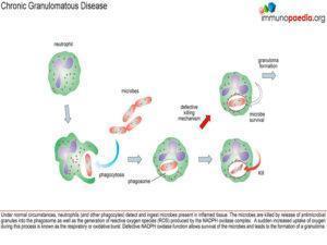 chronic granulomatous disease_Page_1.1