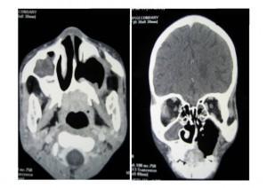 CT scan