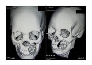 CT scan