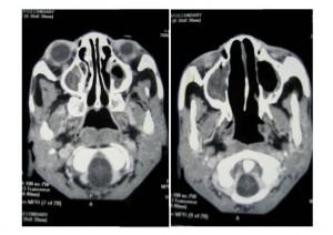 CT scan