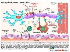 Demylination of nerve cells