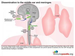 Dissemination to the middle ear and meninges