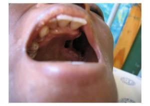 Extensive oral condidiasis