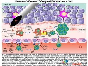 Kawasaki disease false positive Mantoux test