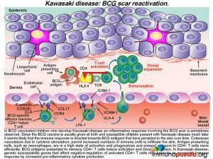 Kawasaki diseases BCG scar reactivation