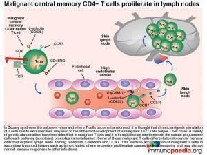 Malignant central memory CD4+ T cells proliferate in lymph nodes