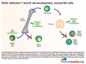 SCID defective T and B cell development normal NK cells