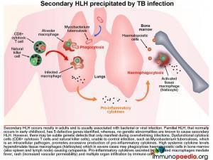 secondary-hlh-precipitated-by-tb-infection