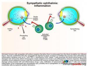 Sympathetic ophthalmia Inflammation