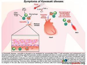 Symptoms of Kawasaki disease