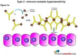 Type 3 - Immune complex hypersensitivity