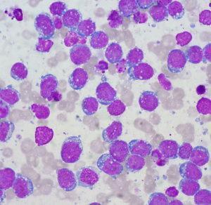 burkitt's lymphoma