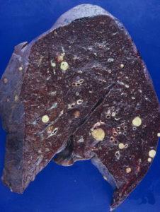 metastatic stage hepatocellular carcinoma