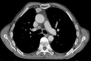 Thymoma CT scan