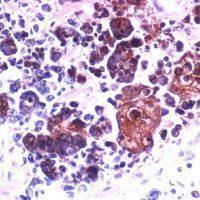 Small cell carcinoma infected with HSV