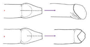 Longitudinal dorsal foreskin cuts