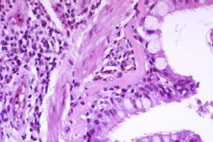 Asthma Goblet cell metaplasia