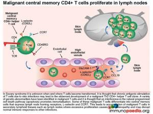 malignant central memory CD4+ T cells proliferate in lymph nodes