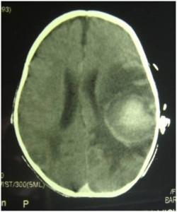 29 days later ct scan shows decreased bleeding and oedema