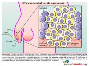 HPV associated penile carcinoma