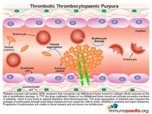 Thrombotic-thrombocytopaenic-purpura2