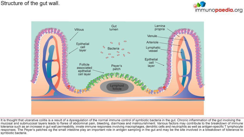 Ulcerative Colitis Case Study Immunopaedia