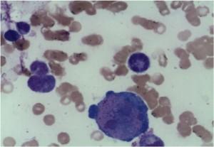 Bone marrow aspirate giant pronormoblasts