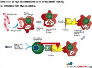 detection-of-mycobacterial-infection-by-mantoux-testing