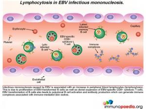Lymphocytosis in EBV infectious mononucleosis