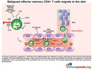 Malignant effector memory CD4+ T cells migrate to the skin
