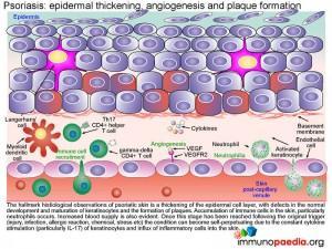 Psoriasis epidermal Thickening angiogenesis and plaque formation