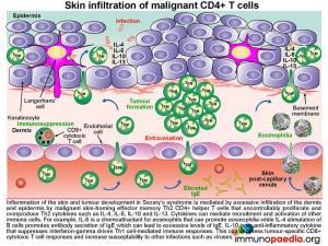 Skin infiltration of malignant CD4+ T cells