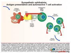 Sympathetic ophthalmia Antigen presentation and autoreactive T cells activation