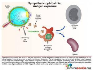 Sympathetic ophthalmia Antigen exposure