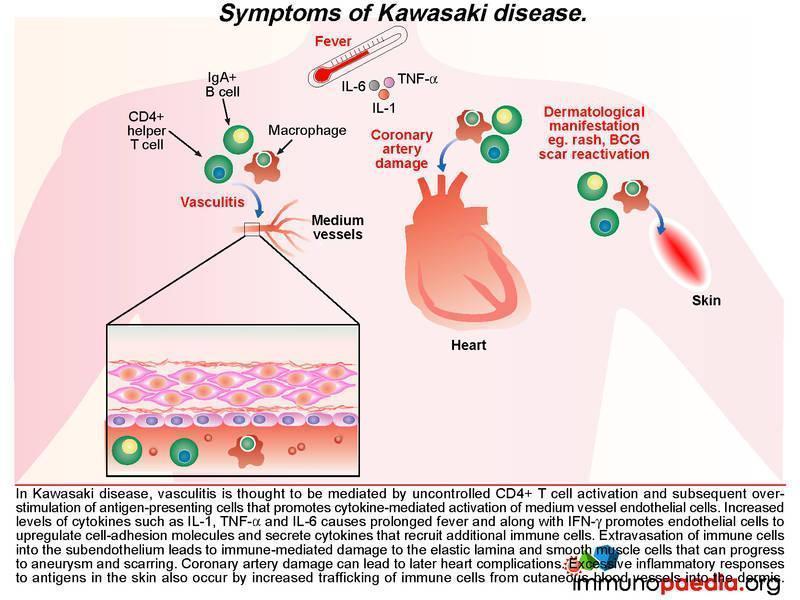 Kawasaki Case Study |