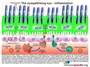 The symphathising eye - inflammation