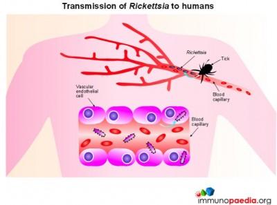 Rickettsia africae Case Study | Immunopaedia Immunopaedia