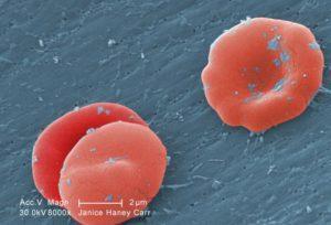 Red blood cell with sickle cell anaemia