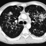 ct image pulmonary TB