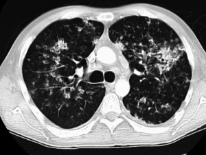 ct image pulmonary TB