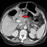 CT Scan of Pancreatic Cancer
