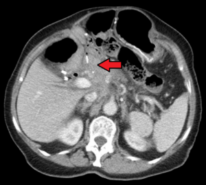 CT Scan of Pancreatic Cancer