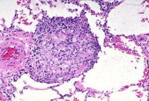 pulmonary tb granuloma