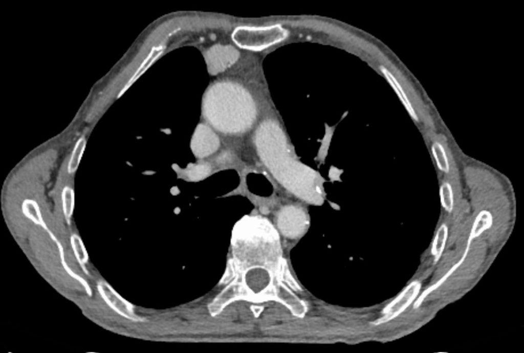 New autoimmune disease driven by thymic tumour Immunopaedia
