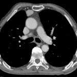 Thymoma CT scan